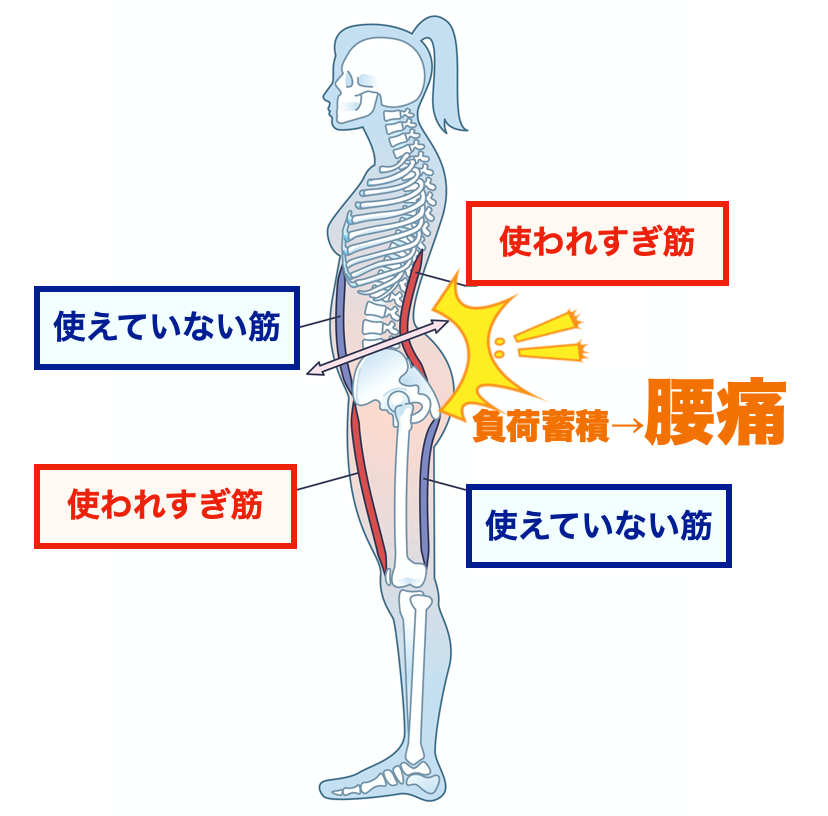 使われすぎ筋と使えていない筋のアンバランスが腰痛の原因